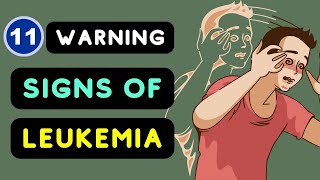 Leukemia Signs and Symptoms Top 11 Warning Signs of Leukemia You Should be Aware of [upl. by Pyotr]