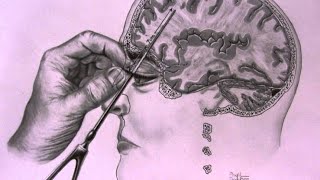 The Most TWISTED Medical Procedure in History  The Lobotomy [upl. by Avek384]