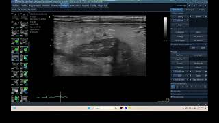 IQ 313 SMALL INTESTINAL ELASTOGRAPHY ULTRASOUND ECHOPAC ANALYSIS [upl. by Milt]