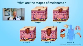 What are the stages of melanoma [upl. by Leban544]