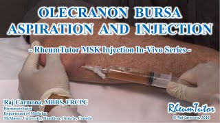 OLECRANON BURSA ASPIRATION  INJECTION  InVivo Series [upl. by Aikas]