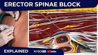 Erector Spinae Plane Block  Regional anesthesia Crash course with Dr Hadzic [upl. by Llenahs]