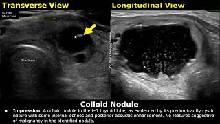 Thyroid Ultrasound Reporting  How To Write USG Scan Reports  Thyroid Pathologies  Small Parts USG [upl. by Uni]