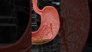 Understanding Hemorrhagic Gastric Ulcers [upl. by Odlabso]