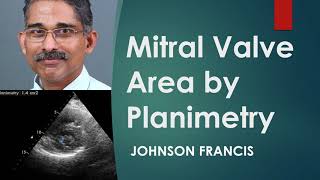 Mitral Valve Area by Planimetry on Echocardiogram [upl. by Hashim345]