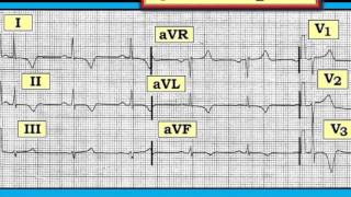 ECG Video16 Blog 120  LV quotStrainquot and Giant T Waves 122112015 [upl. by Vani]