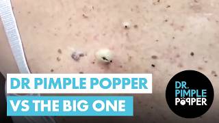 Dr Pimple Popper vs THE BIG ONE [upl. by Raynor]