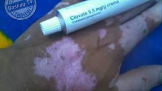 كريم فعال للعلاج البرص Clovate 05 mgg crema [upl. by Htenaj493]