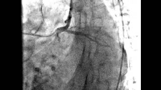 Angiografía coronaria  arterias cardiacas normales [upl. by Reinert]