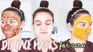 4 DIY Face Masks For ACNE  How To Get Rid Of Pimples OVERNIGHT [upl. by Aldus]