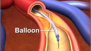 Percutaneous coronary Intervention stenting [upl. by Akemed180]