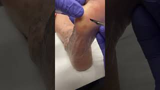 Witness the satisfying transformation Australian podiatrist tackles tough calluses amp corns [upl. by Rankin]