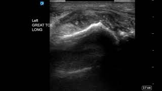 Toe Ultrasound 1st MTP with Suspected Gout Long Axis [upl. by Monson]