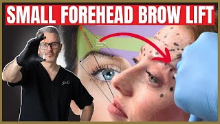 How To Perform a Botox Brow lift on a small forehead [upl. by Mercola]