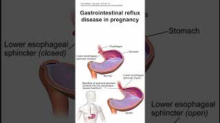 Gastrointestinal reflux disease in pregnancy [upl. by Htiduy]