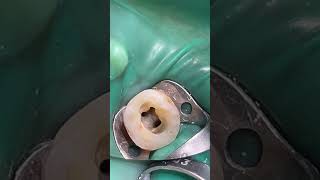 endodontist endodontics rootcanaltreatment rootcanaltherapy [upl. by Ademordna]