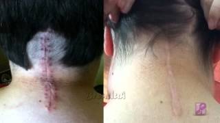 Chiari Malformation 1 Year PostOp [upl. by Gunar]