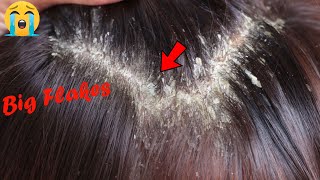 Dry Flaky Scalp Dandruff RemovalDandruff Scratching Satisfying 741 [upl. by Learrsi]