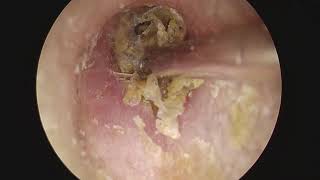 Otomycosis Ear Cleaning Removing Fungal Infection from the Ear 귀 진균증 청소 귀 속 곰팡이 감염 제거하기 [upl. by Ilrac]