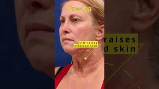 One Year Post FaceliftDeep Neck Lift Examining Poikiloderma [upl. by Yalc]