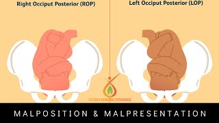 MalpositionOccipito Posterior Position  Hindi Explanation ritikasnursingtutorials [upl. by Bullion]