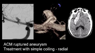 Ruptured Aneurysm Right MCA  Coiling  Radial [upl. by Ugo701]