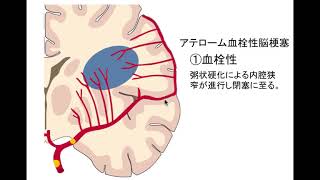 アテローム血栓性脳梗塞の3つの分類 [upl. by Vacuva]