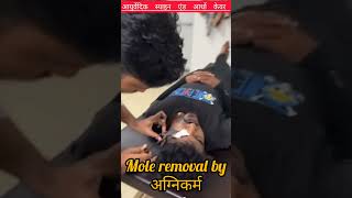 Mole Removal With Agni Karma shorts [upl. by Daffi95]