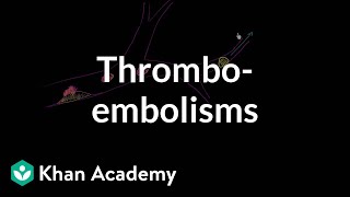 Thromboemboli and thromboembolisms  Miscellaneous  Heatlh amp Medicine  Khan Academy [upl. by Oterol]