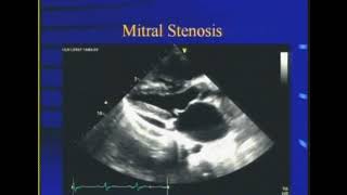 Mitral stenosis Dr S K Parashar [upl. by Chaille]