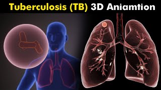 What Happens in Tuberculosis TB  3D Animation  Types Causes Symptoms Treatment UrduHindi [upl. by Eecyac]