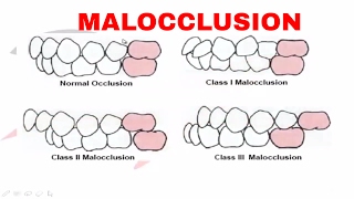 Malocclusion  Part I [upl. by Braswell]