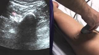 Ultrasound Guided Anterior Sciatic Nerve Block  SSRAUSAcom [upl. by Bilek]