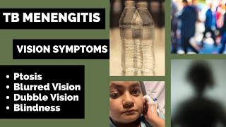 TB Meningitis  Vision symptoms  Double Vision  Blurred Vision  Explained in Hindi [upl. by Roye216]