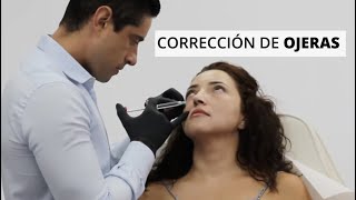 Corrección de ojeras con ácido hialurónico  Clínicas Esquivel [upl. by Four7]