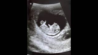 A Subchorionic Hemorrhage Killed Our Baby Miscarriage Vlog [upl. by Aretina647]