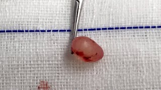 Epididymal Cyst [upl. by Willdon]