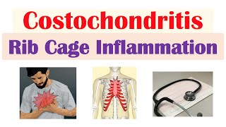 Costochondritis Rib Cage Inflammation  Causes Symptoms Diagnosis Treatment [upl. by Habas]