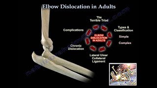 Elbow Dislocation In Adults  Everything You Need To Know  Dr Nabil Ebraheim [upl. by Eecrad]