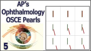 APs Ophthalmology OSCE Pearls 5 [upl. by Ltihcox262]