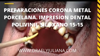 Preparación de Coronas Metal Porcelana 👅 video1515 Impresión Definitiva PolivinilSiloxano [upl. by Borman353]