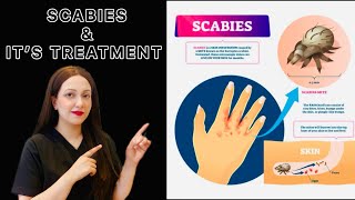 Scabies amp It’s Treatment  Dr Hira Khan [upl. by Ainesey]