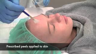 Acne chemical peel [upl. by Ecinna]