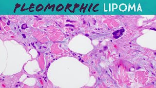 Pleomorphic lipoma amp Spindle cell lipoma Basic soft tissue pathology dermpath dermatology USMLE [upl. by Enyleve289]