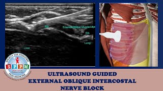 External Oblique Intercostal Ultrasound Guided Nerve Block [upl. by Schulman222]