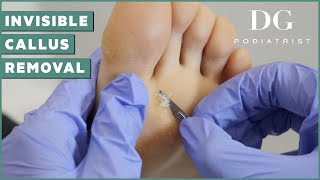 Callus removal from feet a young yoga instructor  The Foot Scraper DG Podiatrist [upl. by Gelb]