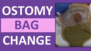 Ostomy Bag Pouch Change  Ostomy Care Nursing  Colostomy Ileostomy Bag Change [upl. by Kcirret840]