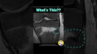 Fig 4B25 Ogden Type IV Tibial Tuberosity Fracture [upl. by Nagn]