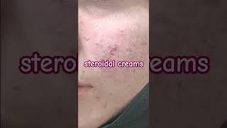 Whitening Cream Side Effects l Red Face [upl. by Loleta]