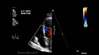 Eccentric tricuspid regurgitation jet suggests flail leaflet [upl. by Eloci860]